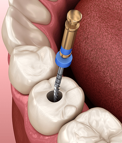 Treatment - Silk Dental